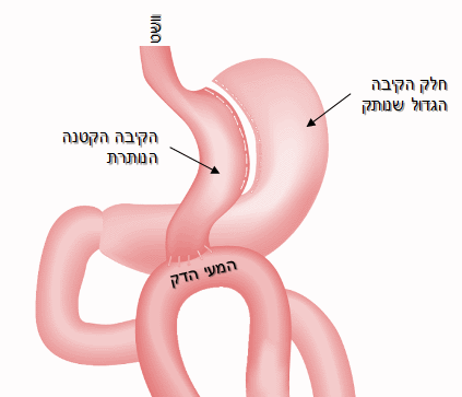 מיני מעקף קיבה